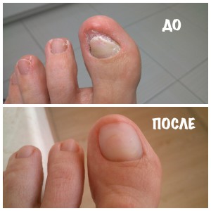 протезирование ногтей до и после