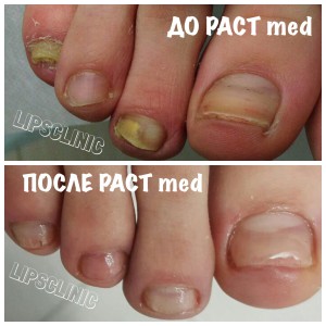 до и после проведения сеансов PACT Med
