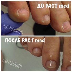 до и после проведения сеансов PACT Med