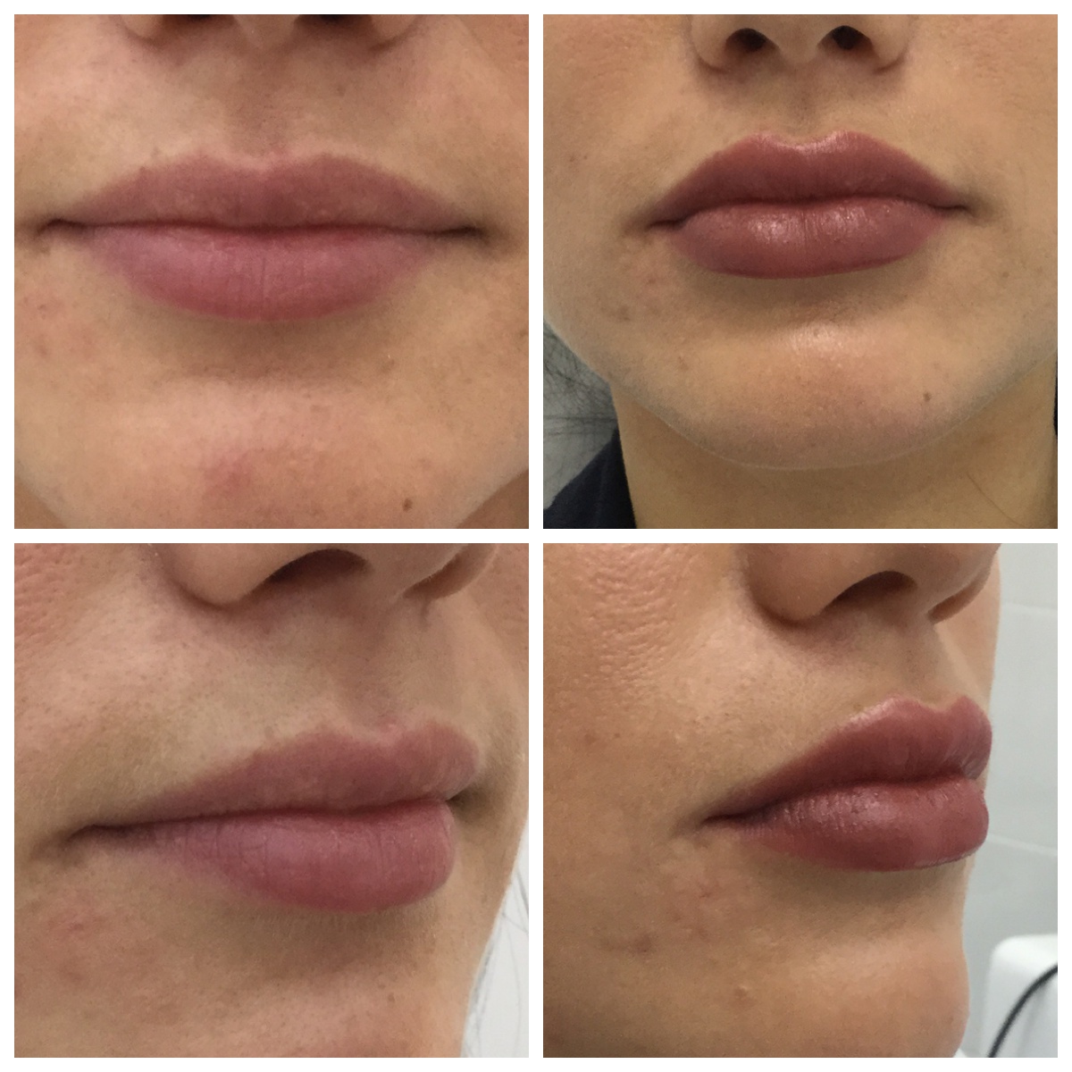 Удаление малых губ до и после фото. Коррекция губ. Коррекция формы губ. Увеличение губ до и после. Липофилинг губ фото до и после.