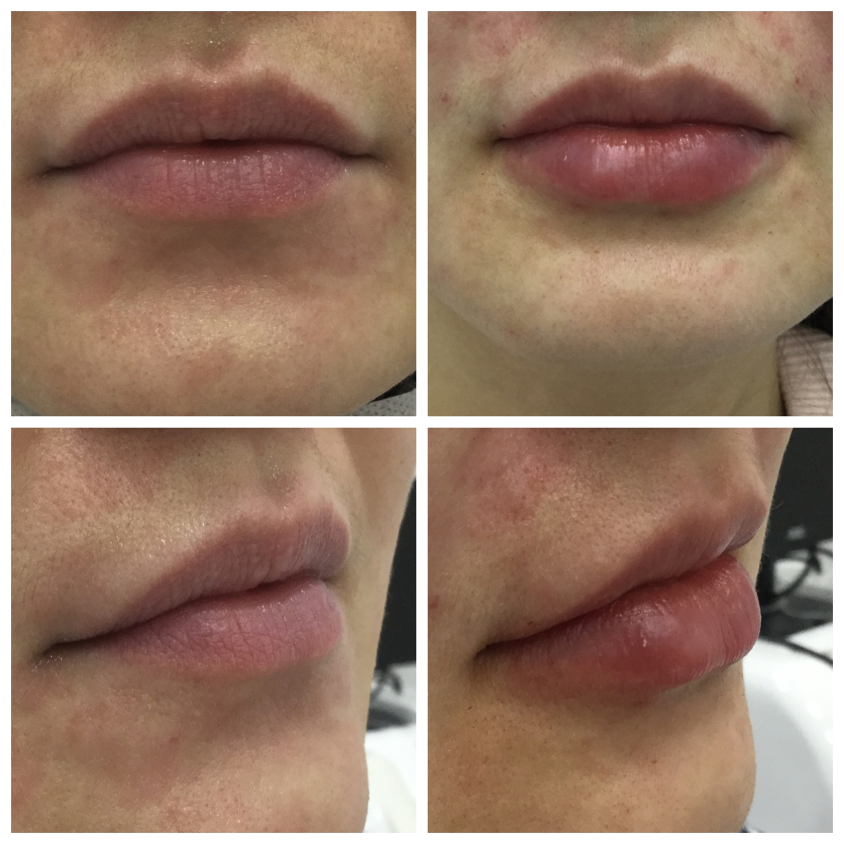 Коррекция губ гиалуроновой кислотой фото до и после