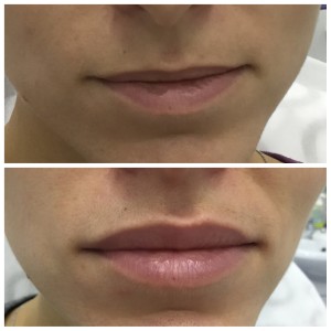 До и после коррекции формы и объема губ