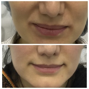До и после коррекции формы и объема губ